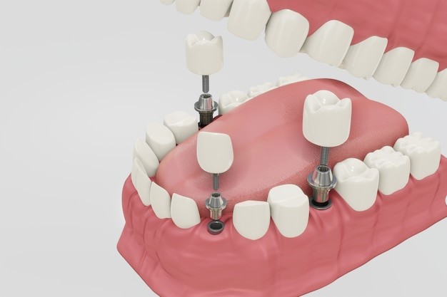 dental implants in Dubai