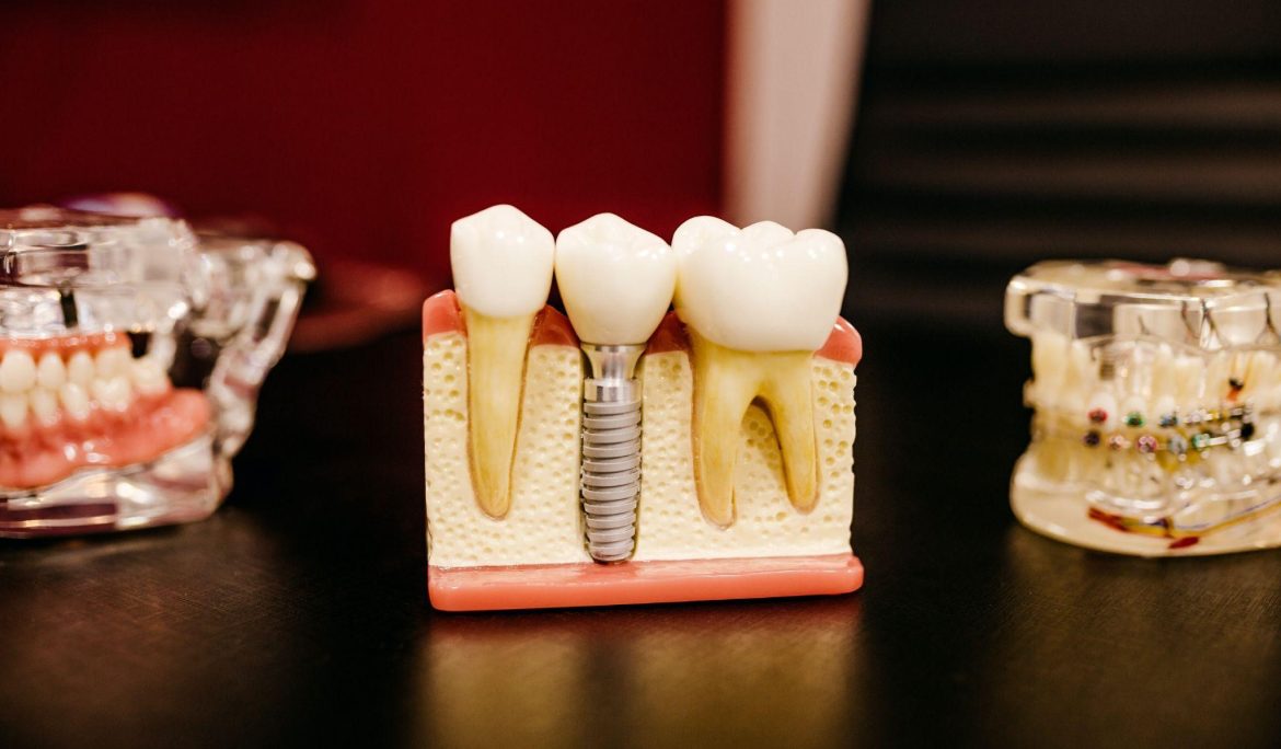 What are the advantages of dental implants?