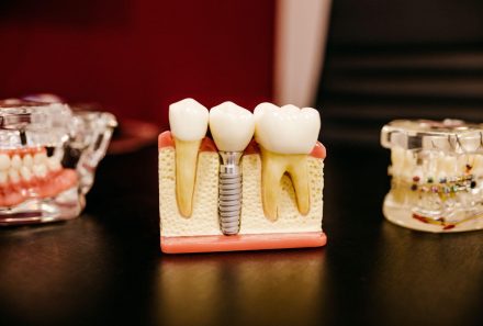 What are the advantages of dental implants?