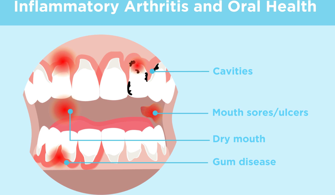 How gum diseases hamper mental health & autoimmune conditions?