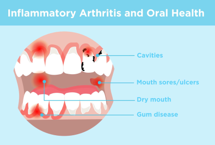 How gum diseases hamper mental health & autoimmune conditions?