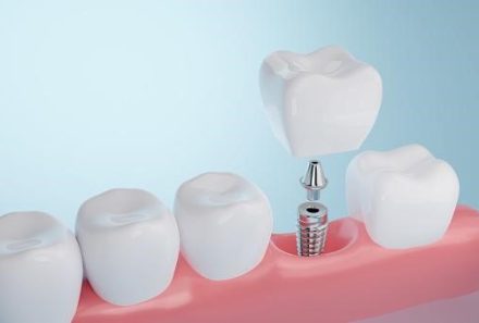 Aspects That Impact the Cost of Dental Implants