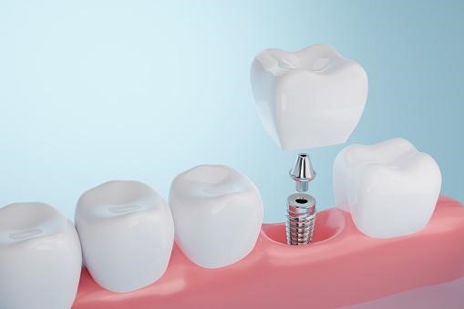 dental implants treatment dubai
