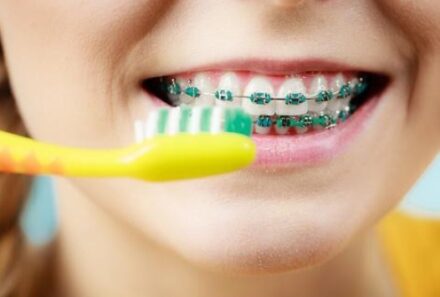 Dental Braces: What You Need to Know