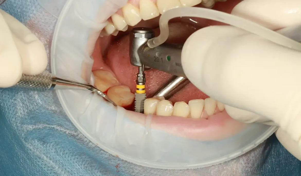 All-on-4 Dental Implants: The Revolutionary Solution for Missing Teeth