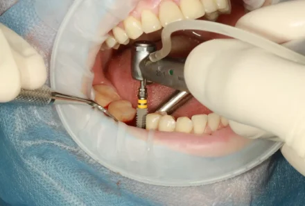 All-on-4 Dental Implants: The Revolutionary Solution for Missing Teeth