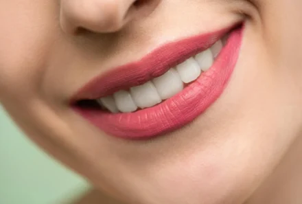 Laser Teeth Whitening in Dubai: How It Works and What to Expect